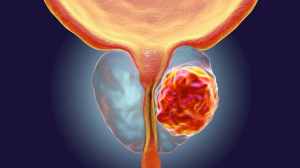 La inteligencia artificial cambia el diagnóstico del cáncer de próstata: menos biopsias y más precisión