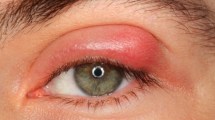 Imagen de Por qué aparecen los orzuelos y cómo tratarlos para una recuperación rápida