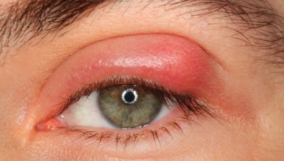 Cómo curar un orzuelo?