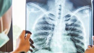 Qué es la tuberculosis y cómo se contagia: especialistas aseguran que se puede «prevenir y curar»