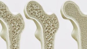 Cómo funciona la nueva técnica que busca revertir el avance de la osteoporosis