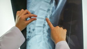 Indemnización en Neuquén: tiene 33 años y la columna de un hombre de 60, la Justicia reconoció su dolor