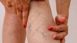 Cómo prevenir las várices a través de una rutina de ejercicios