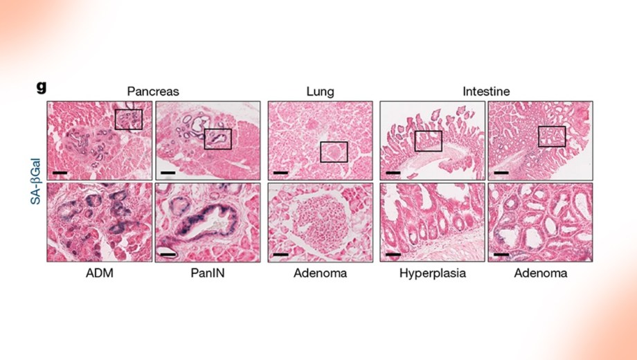 La imagen muestra cómo el oncogén KRAS impulsa la evolución del cáncer de forma distinta en cada órgano. Foto: CONICET.