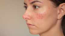 Imagen de Identificá y controlá la rosácea: disparadores y rutina mínima para cuidar tu piel