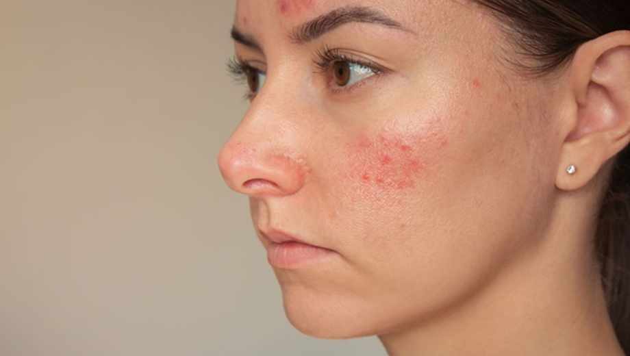 Rosácea: cómo mejorar el estado de tu piel.-