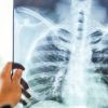 Imagen de Confirman un caso de tuberculosis en una provincia de la Patagonia: es el segundo en una semana