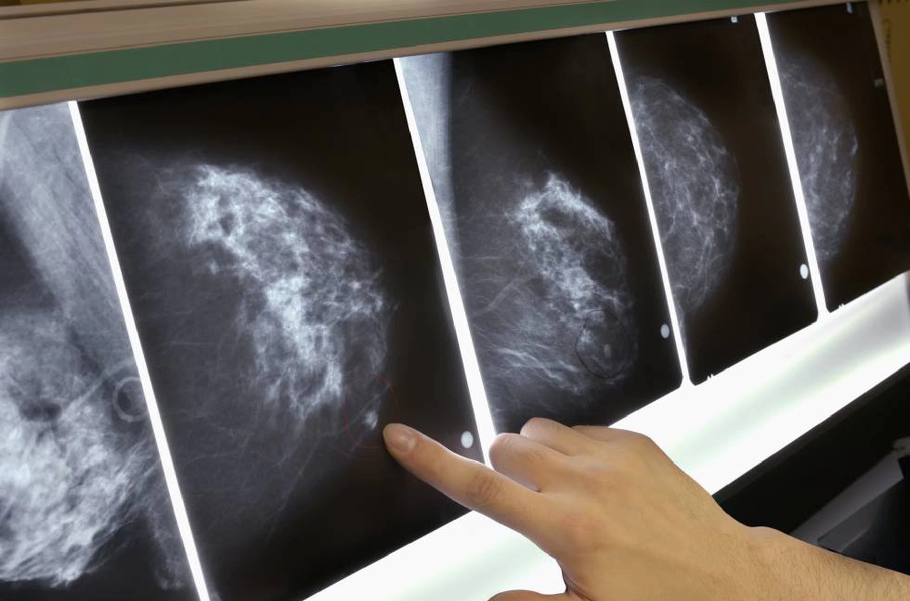 Viedma implementa una licencia laboral para detección temprana del cáncer