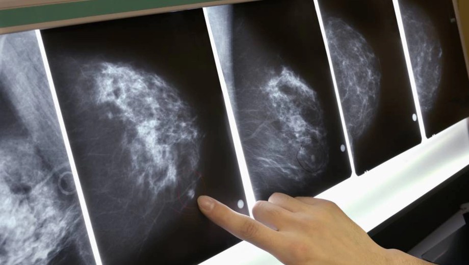 El cáncer de mama es la primera causa de muerte por cáncer en mujeres, pero en estadios tempranos la tasa de supervivencia supera el 90%. (Foto: archivo).
