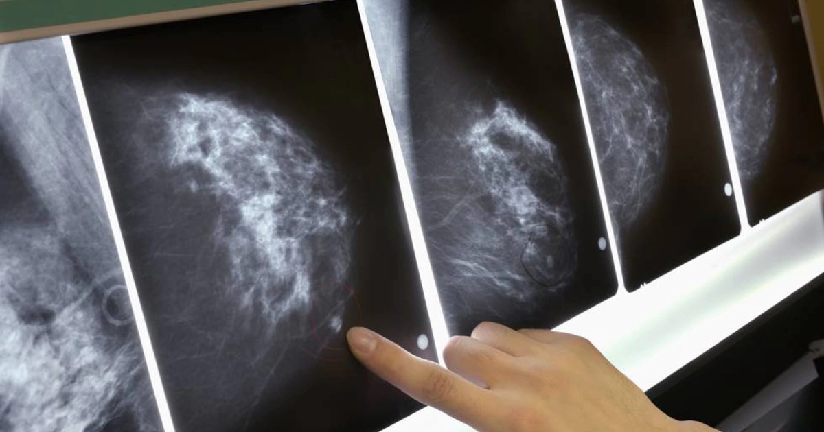Viedma implementa una licencia laboral para detección temprana del cáncer