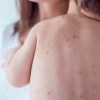 Imagen de Dos casos sospechosos de rubéola en bebes recién nacidos de Roca: refuerzan la vacunación