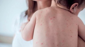 Dos casos sospechosos de rubéola en bebes recién nacidos de Roca: qué se sabe hasta ahora
