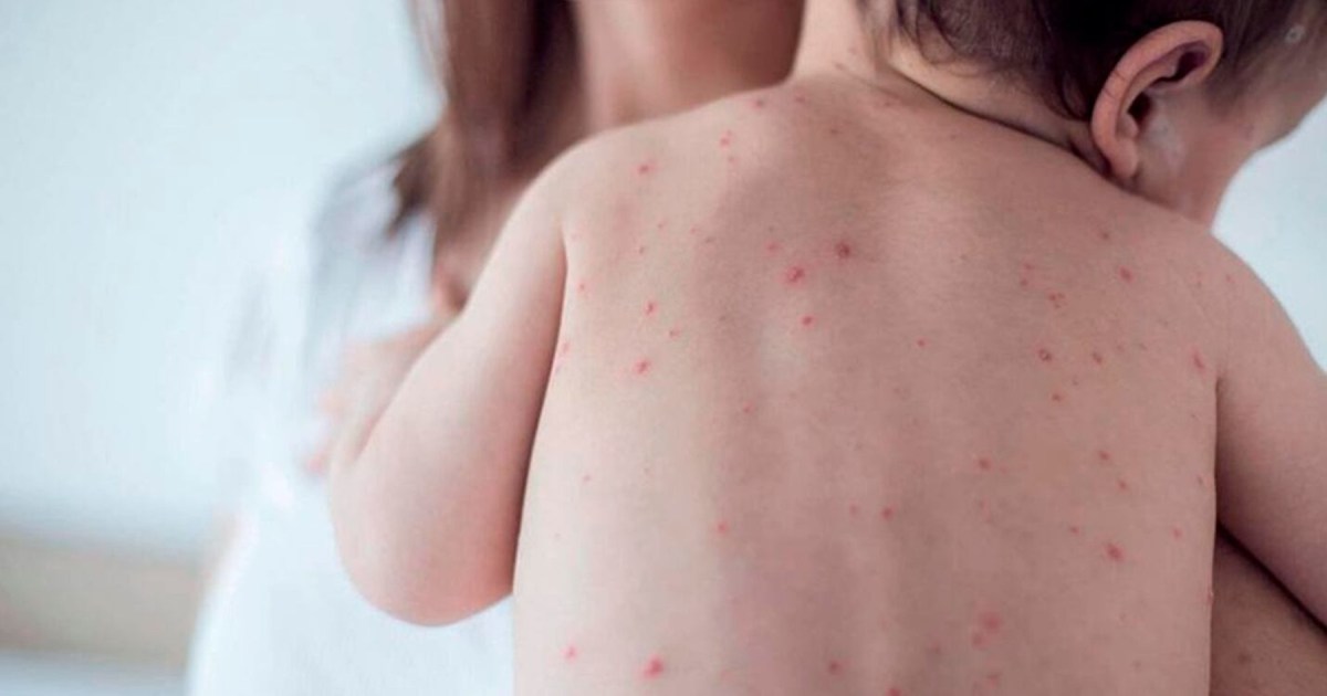 Fruth Rubeola Dos casos sospechosos de rubéola en bebes recién nacidos de Roca: qué ...