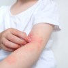 Imagen de Niños con alergias: por qué los especialistas recomiendan no eliminar alimentos ni medicamentos por cuenta propia