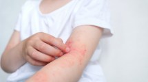 Imagen de Niños con alergias: por qué los especialistas recomiendan no eliminar alimentos ni medicamentos por cuenta propia