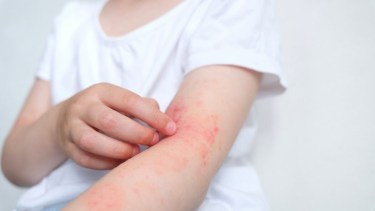 Niños con alergias: por qué los especialistas recomiendan no eliminar alimentos ni medicamentos por cuenta propia