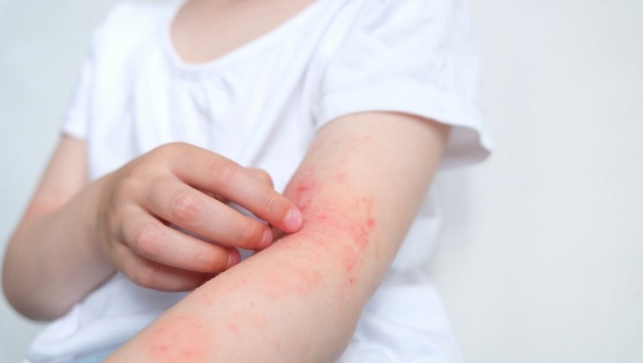 Se estima que 3 de cada 10 niños en Argentina tiene alergia. Foto: gentileza