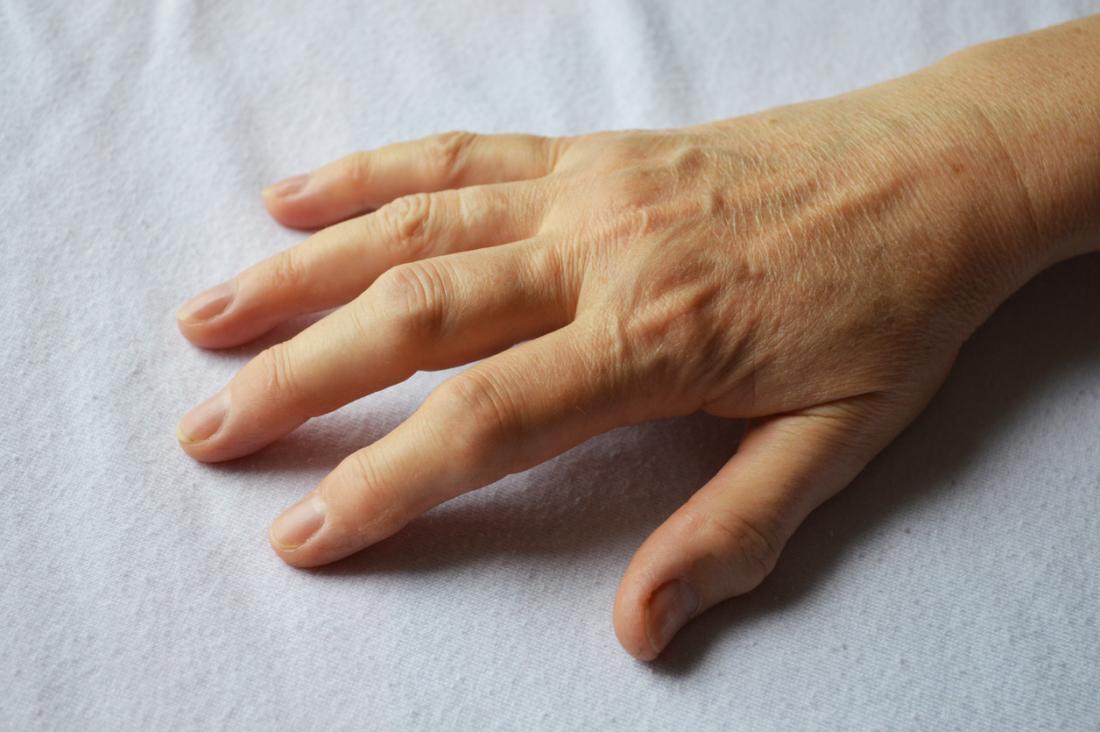 La artritis en las manos: síntomas y consejos para aliviar el dolor