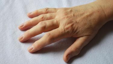 La artritis en las manos: las señales que no conviene ignorar y qué hacer para aliviar el dolor
