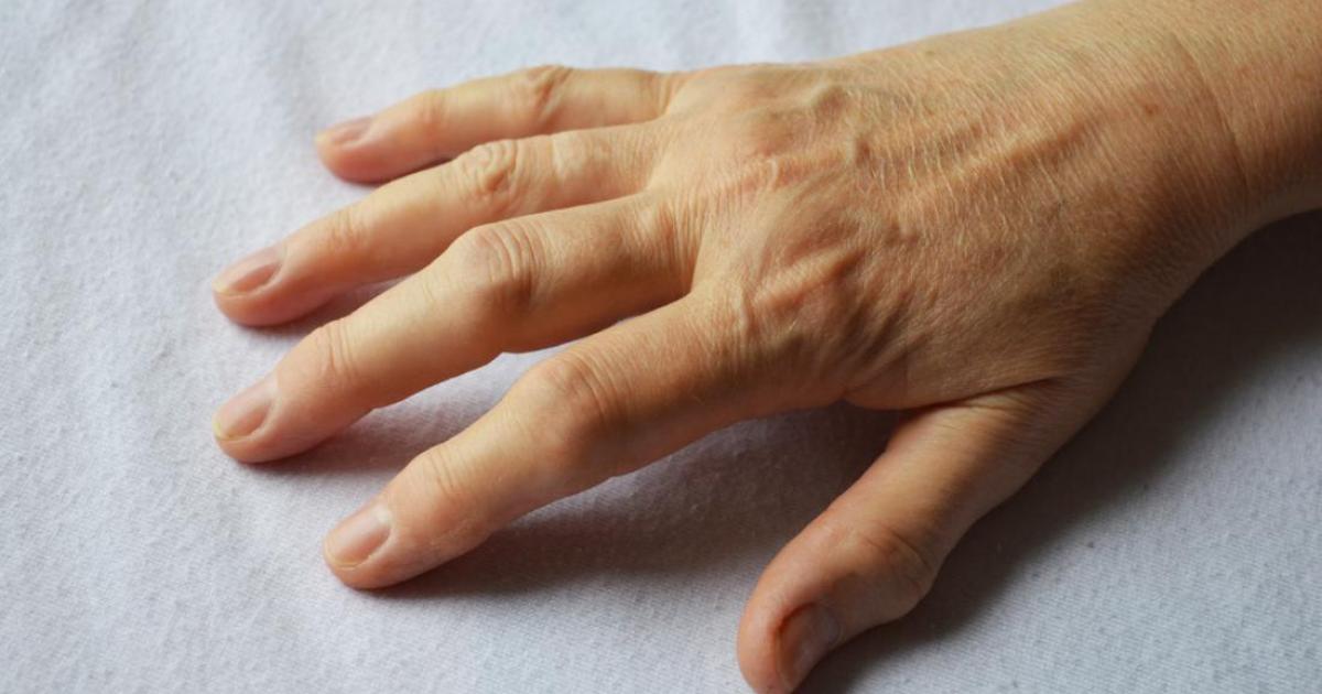 La artritis en las manos: síntomas y consejos para aliviar el dolor