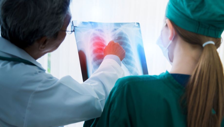 El cáncer de pulmón de células no pequeñas es el tipo más frecuente de tumor pulmonar en el mundo
