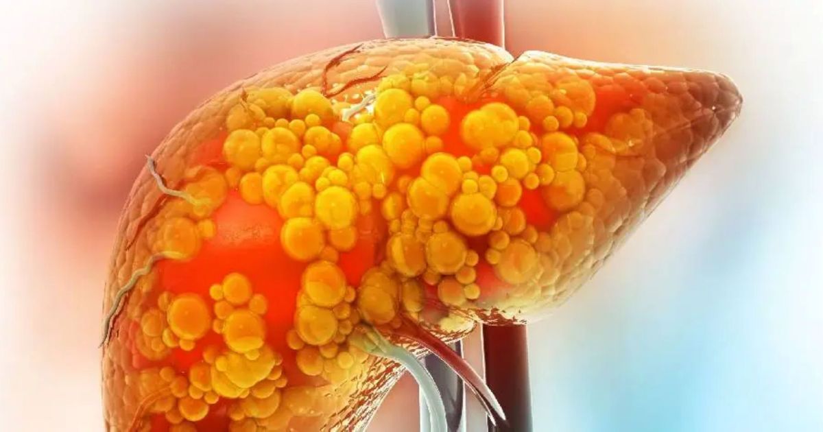 Nuevo descubrimiento sobre hígado graso permite identificar casos de riesgo