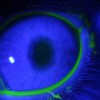 Imagen de ¿Chau a las gotas? Científicos argentinos crean un minidispositivo 3D contra el glaucoma