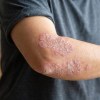 Imagen de Día Mundial de la Psoriasis: tener poca piel afectada no siempre significa una enfermedad leve