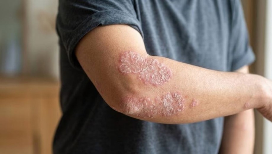 La psoriasis es una enfermedad inflamatoria crónica. Foto: Agencia NA (Magnific)