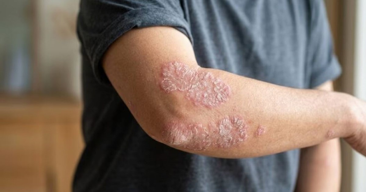 Día Mundial de la Psoriasis: Impacto en la calidad de vida de los pacientes