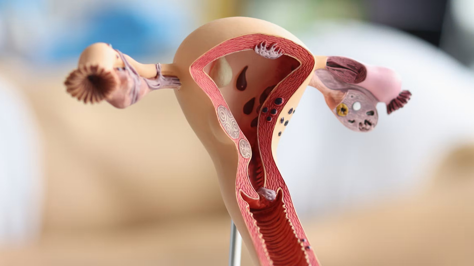 Endometriosis: el desafío de tratar el dolor más allá de las hormonas