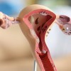 Imagen de Endometriosis: cuando controlar las hormonas no basta para frenar el dolor